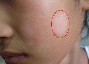 孩子脸上的白斑是虫斑还是白癜风?