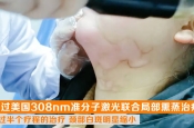 外用药物治疗多年无果，美国308激光后效果显著！